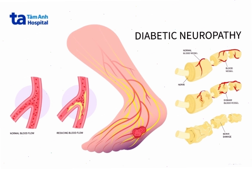 Bệnh thần kinh ngoại biên gây tê bì chân
