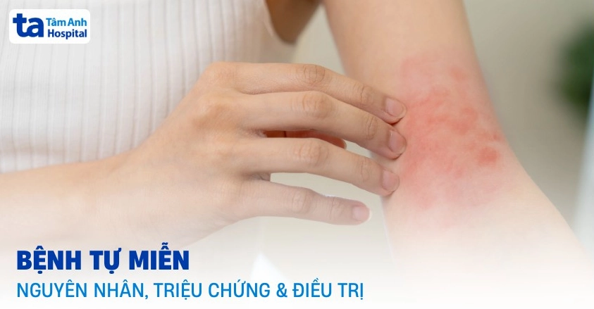 Bệnh tự miễn là những bệnh gì và cách nhận diện nguy cơ sức khỏe