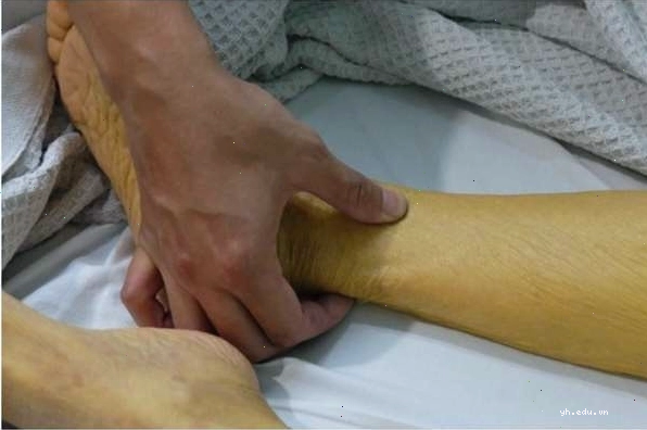 Bệnh vàng da ở người lớn