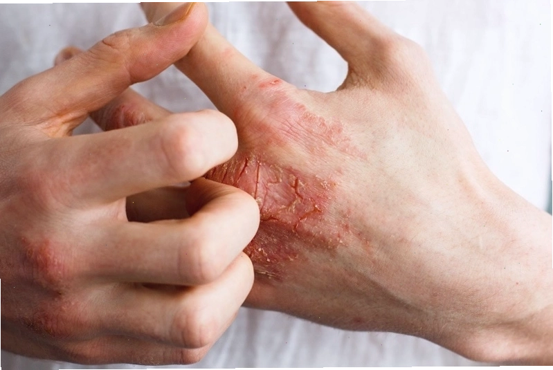 Bệnh viêm da tiếp xúc làm da tay bị đau nứt, bong tróc và ngứa ngáy