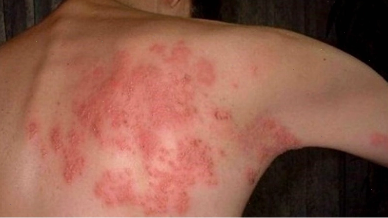 Bệnh zona thần kinh do virus Varicella zoster gây ra