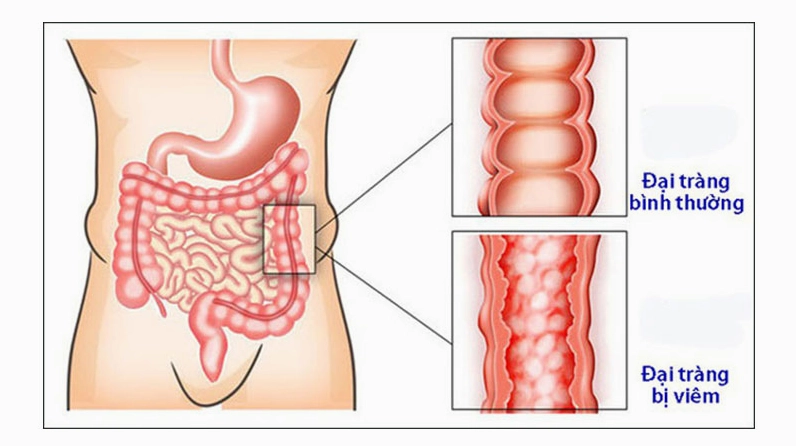 Bị bệnh đại tràng là gì và các kiến thức y khoa cần biết ngay