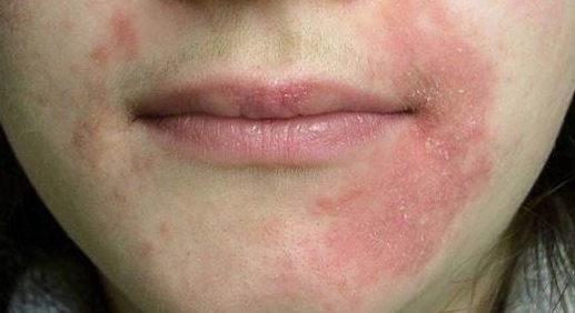 Bị chàm là bệnh gì và những điều cần biết để bảo vệ làn da
