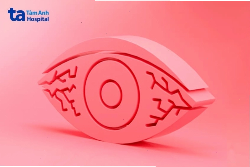 bị đỏ mắt