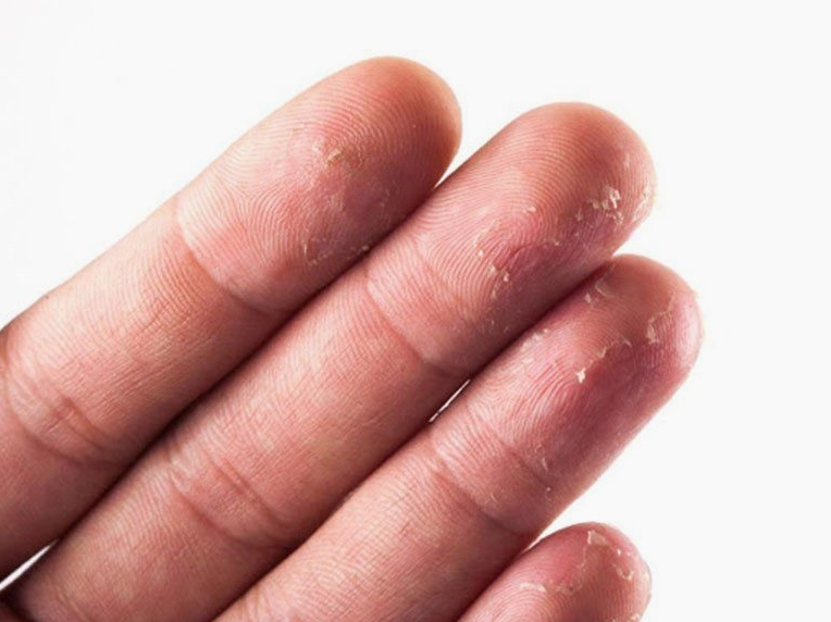 Bị lột da đầu ngón tay là bệnh gì và cách xử lý hiệu quả nhất