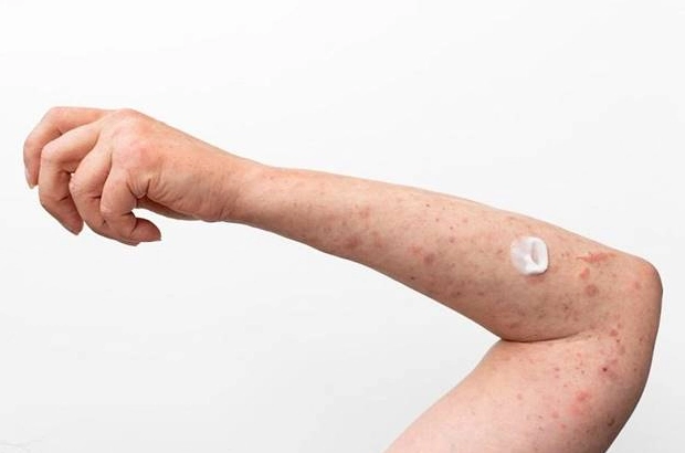 Bị mụn ở bắp tay là bệnh gì và các cách xử lý khoa học tại nhà