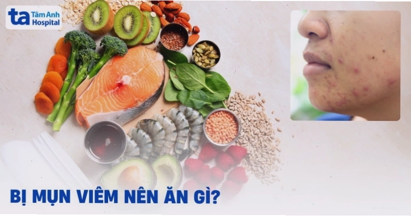 Bị mụn viêm nên ăn gì để cải thiện tình trạng da