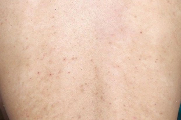 Biến chứng mụn lưng