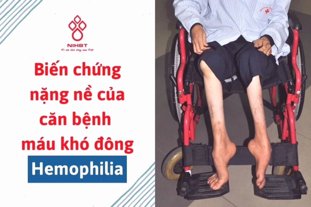 Biến chứng nặng nề của bệnh máu khó đông Hemophilia