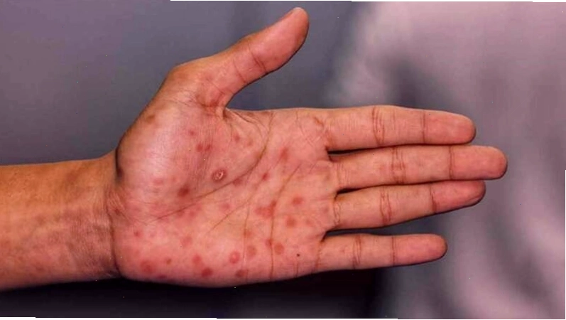 Biến chứng nhiễm trùng đường miệng