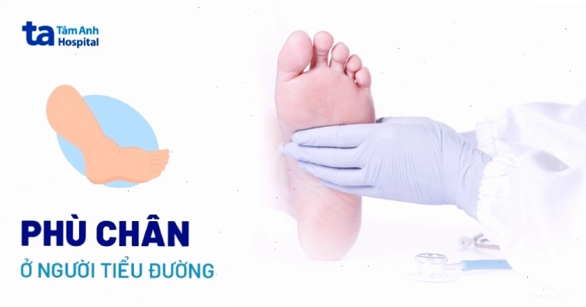 Biến chứng phù chân ở người tiểu đường