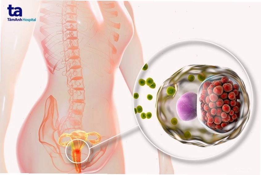 Biến chứng viêm vùng chậu do Chlamydia