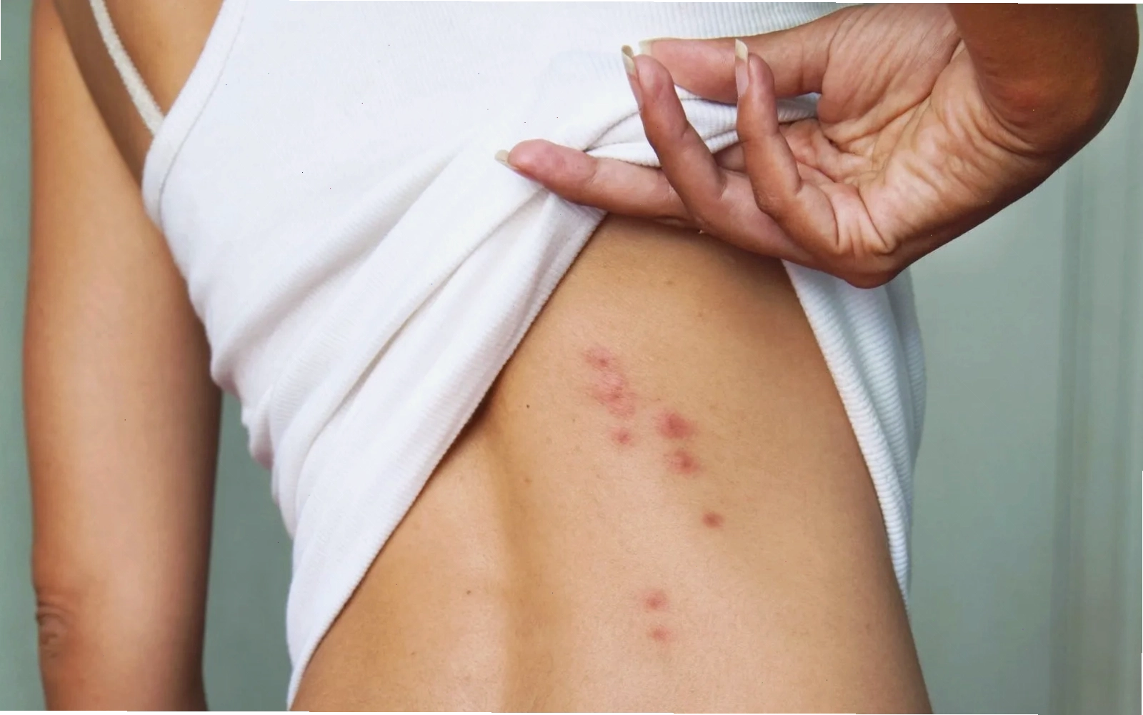Biện pháp bảo vệ da khỏi côn trùng đốt