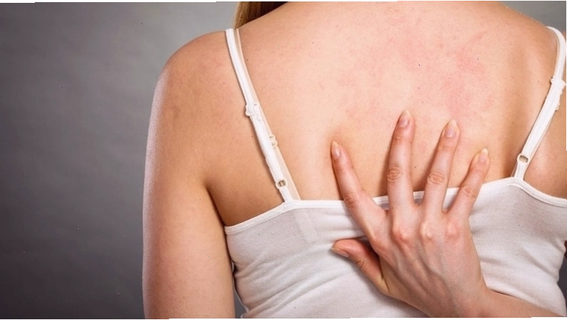 Biểu hiện bệnh chàm khô ở lưng cần được chữa trị an toàn