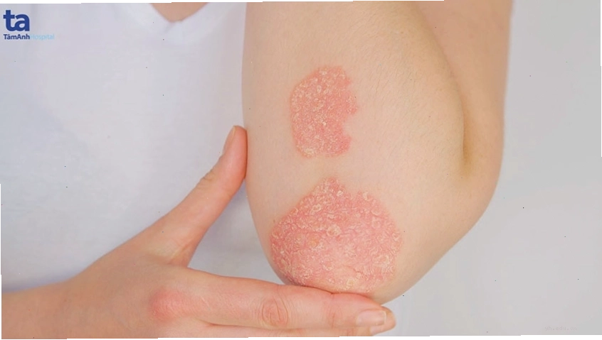 Biểu hiện bệnh vẩy nến trên da