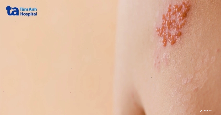 Biểu hiện đỏ rát và mụn nước trên da