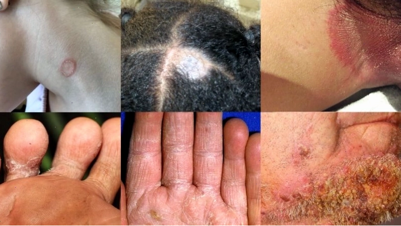 Biểu hiện hắc lào ở các vị trí khác nhau