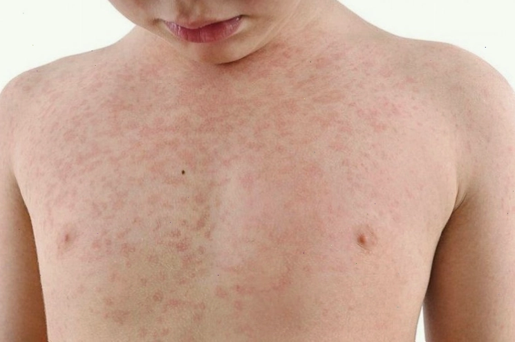 Biểu hiện phát ban đặc trưng của bệnh Rubella