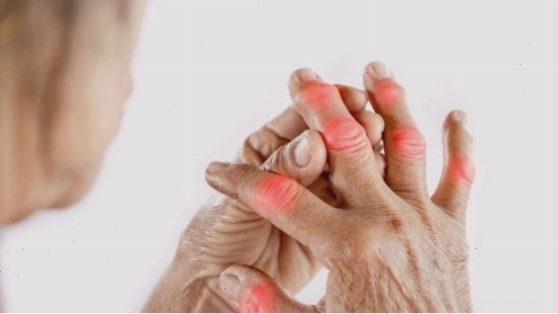 Biểu hiện sưng đỏ ở các khớp ngón tay người bệnh