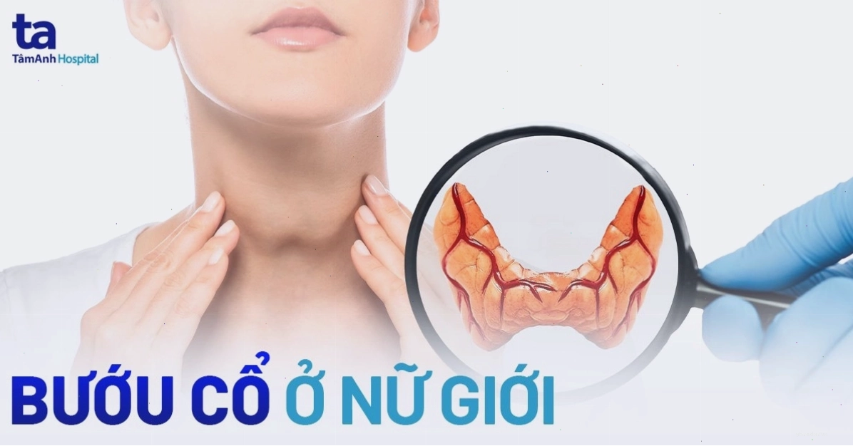 bướu cổ ở nữ giới nguyên nhân và dấu hiệu