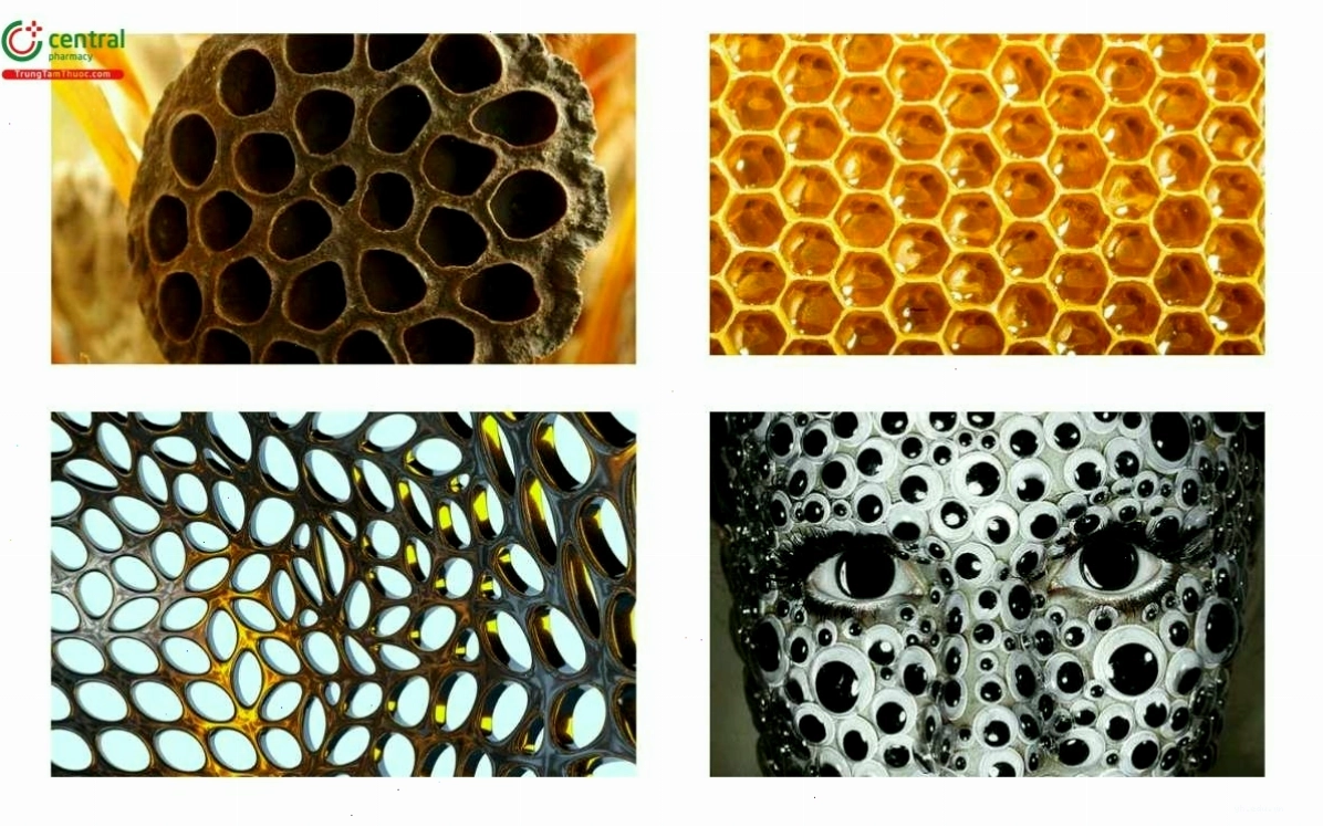 Các bài kiểm tra trực quan về hội chứng sợ lỗ