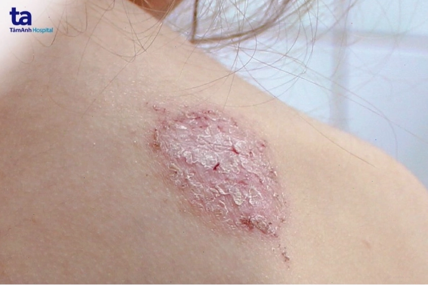 Các biến chứng của chàm đồng tiền