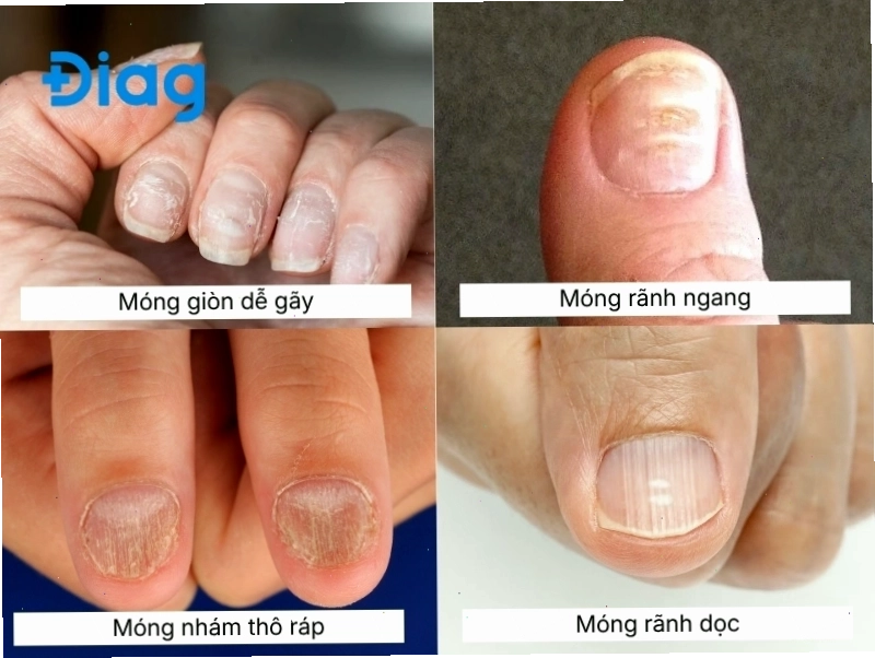 Các biểu hiện móng bất thường phổ biến ở người trưởng thành