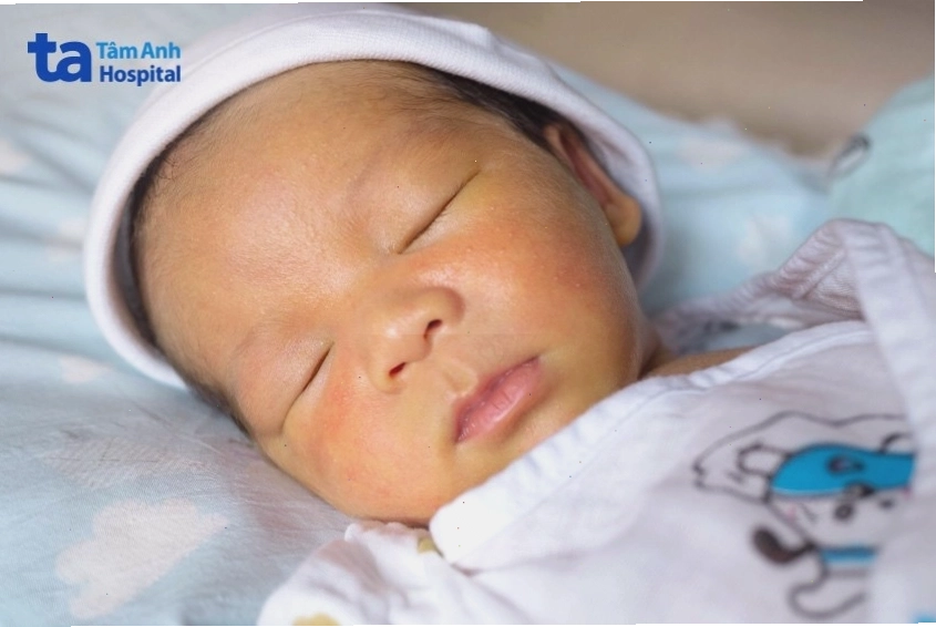 Các biểu hiện nhận biết sớm tình trạng vàng da
