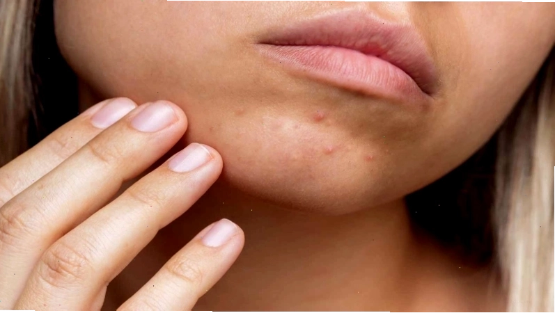 Các bước chăm sóc da mụn cơ bản tại nhà