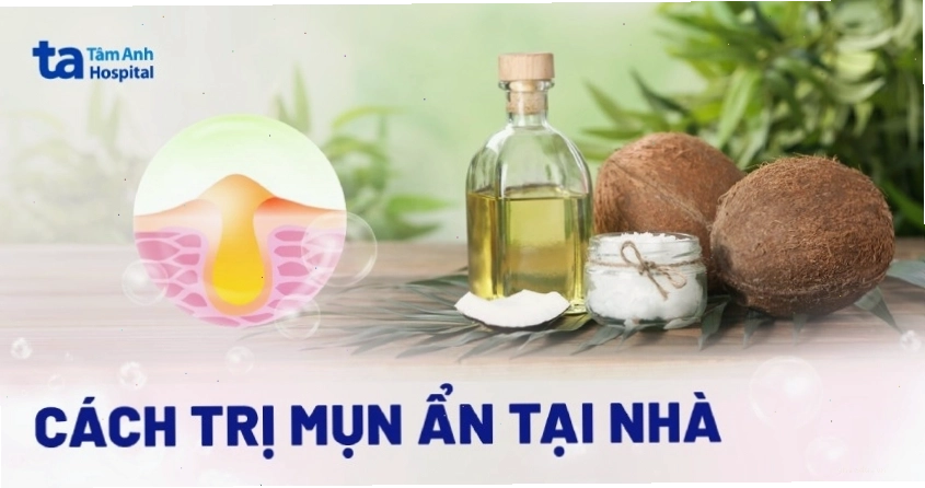 Các cách hỗ trợ điều trị mụn tại nhà