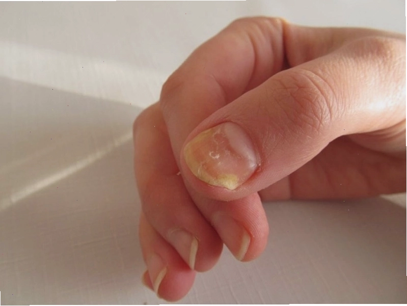 Các chấn thương cơ học tại vùng móng có thể gây ra hiện tượng biến dạng hoặc lõm móng
