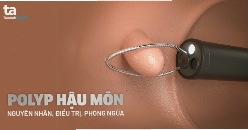 Các dấu hiệu nhận biết polyp