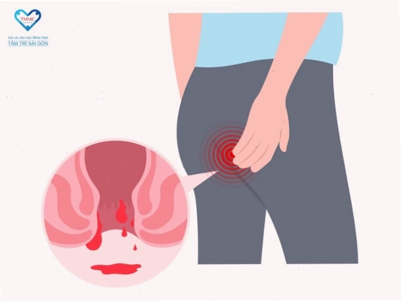 Các dấu hiệu nhận biết triệu chứng nứt kẽ hậu môn điển hình