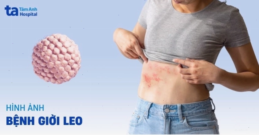 Các giai đoạn tiến triển hình ảnh bệnh giời leo