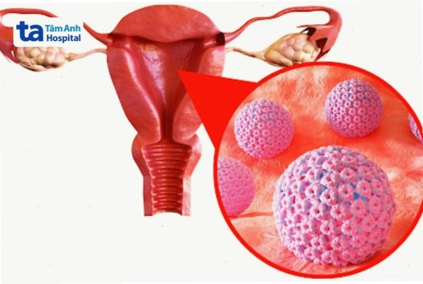 Các loại HPV gây ung thư
