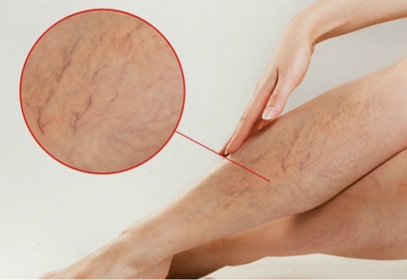 Các loại thuốc hỗ trợ điều trị suy tĩnh mạch