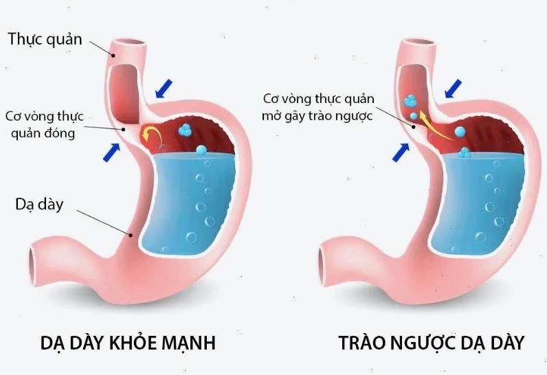 Các nguyên nhân chính gây ra tình trạng khó nuốt