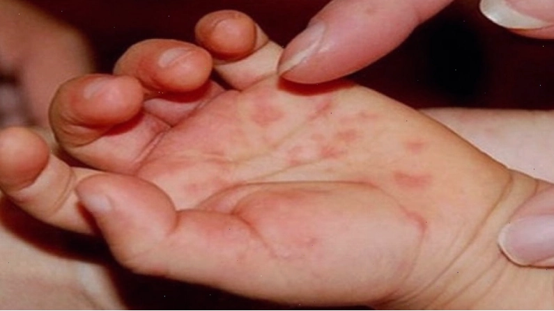 Các nốt ban đỏ trên da do nhiễm Enterovirus