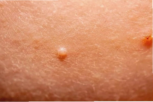 Các nốt do virus Molluscum contagiosum gây bệnh