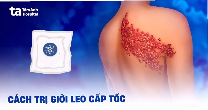 Các phương pháp điều trị giời leo bằng y khoa hiện đại