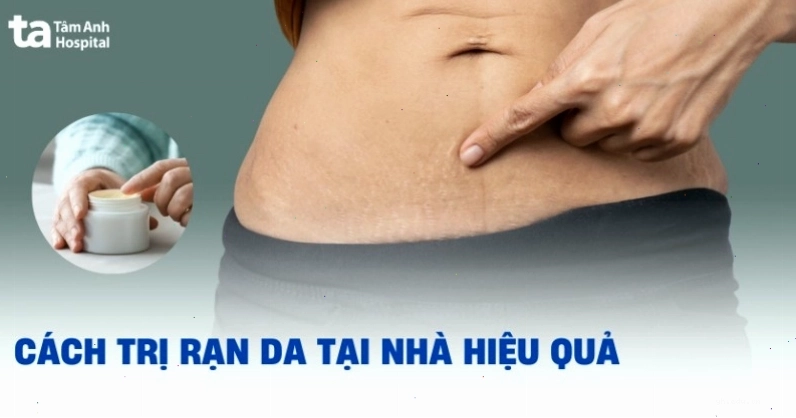 Các phương pháp điều trị rạn da tại nhà giúp cải thiện độ đàn hồi