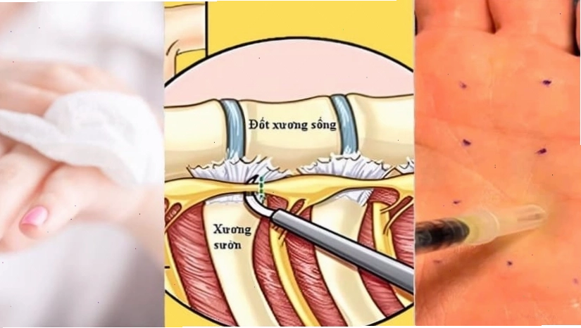 Các phương pháp điều trị tăng tiết mồ hôi
