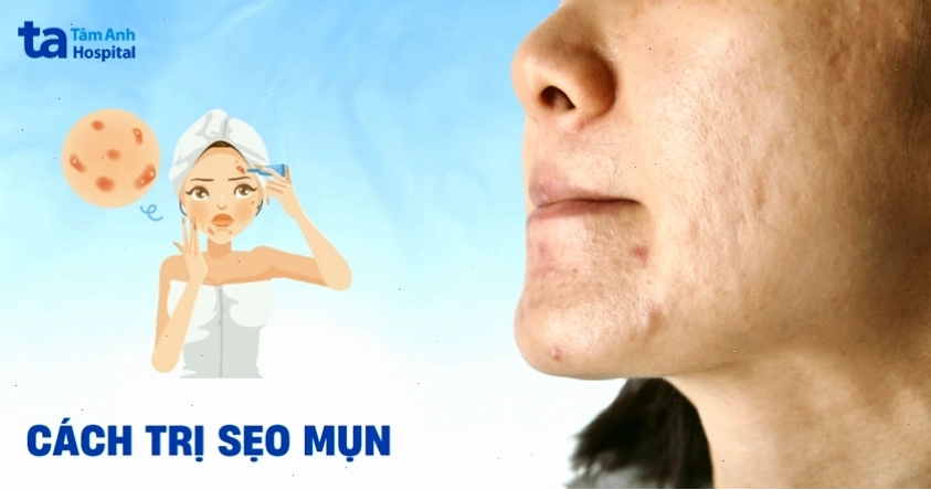 Các phương pháp trị sẹo mụn lâu năm chuẩn y khoa