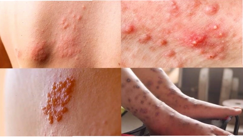 Các triệu chứng của nhiễm trùng da rất đa dạng