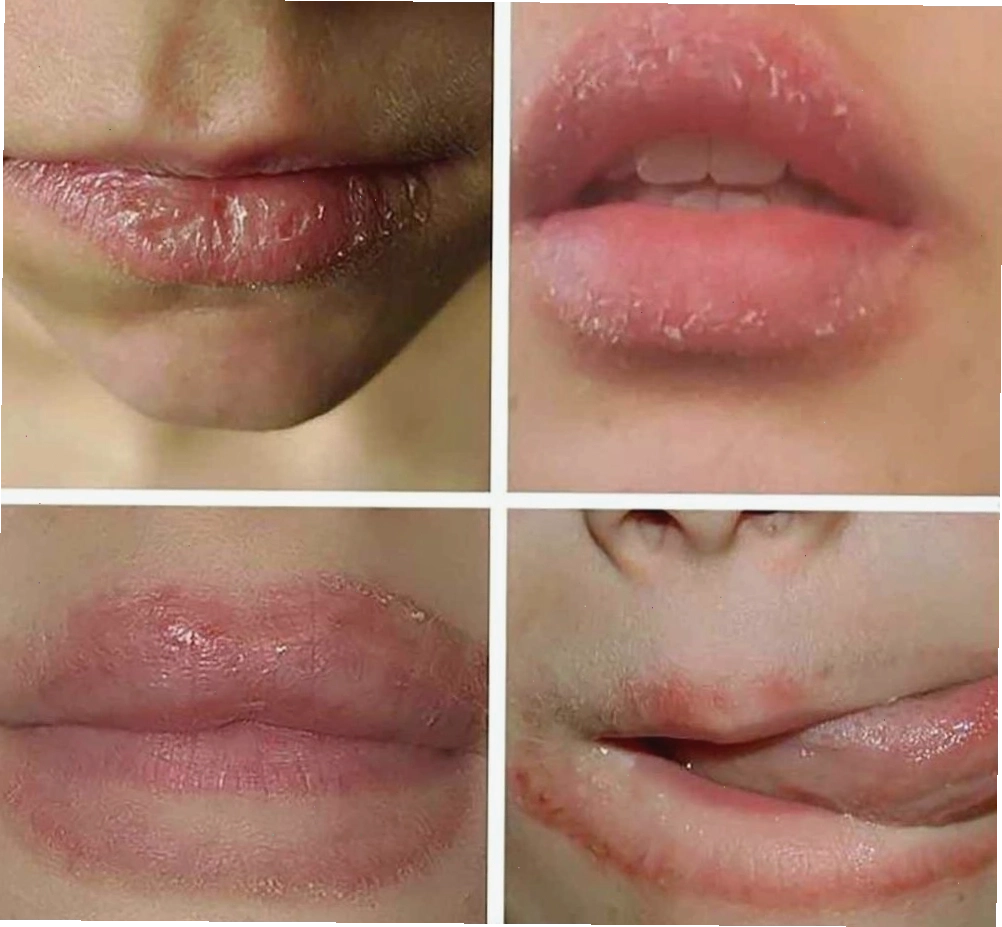 Các triệu chứng mẩn đỏ và bong tróc da trên môi