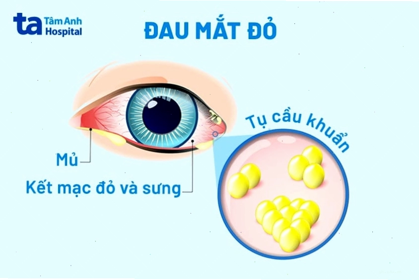 Các triệu chứng nhận biết bệnh đau mắt đỏ