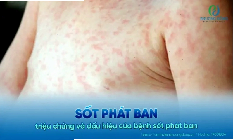 Các triệu chứng nhận biết bệnh sốt phát ban