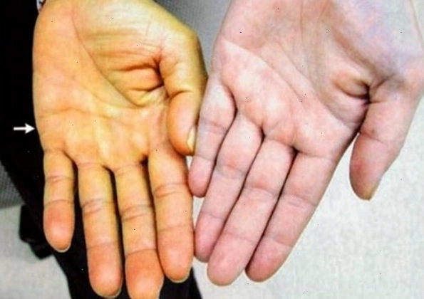Các triệu chứng nhận biết tình trạng vàng da do bệnh lý
