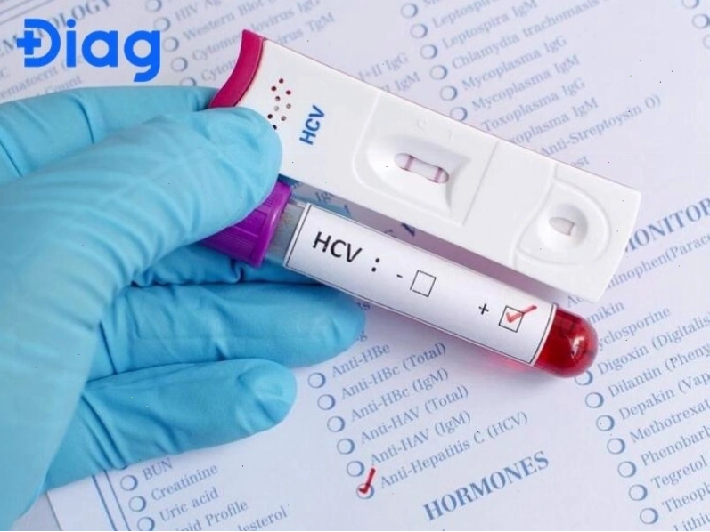 cách đọc kết quả định lượng virus viêm gan c