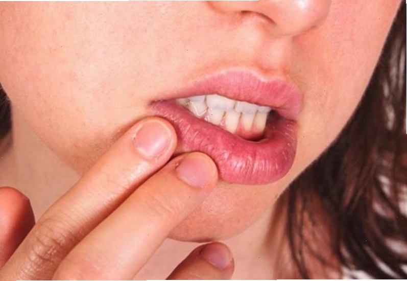 Cách ngăn ngừa yếu tố nguy cơ tái phát mụn rộp